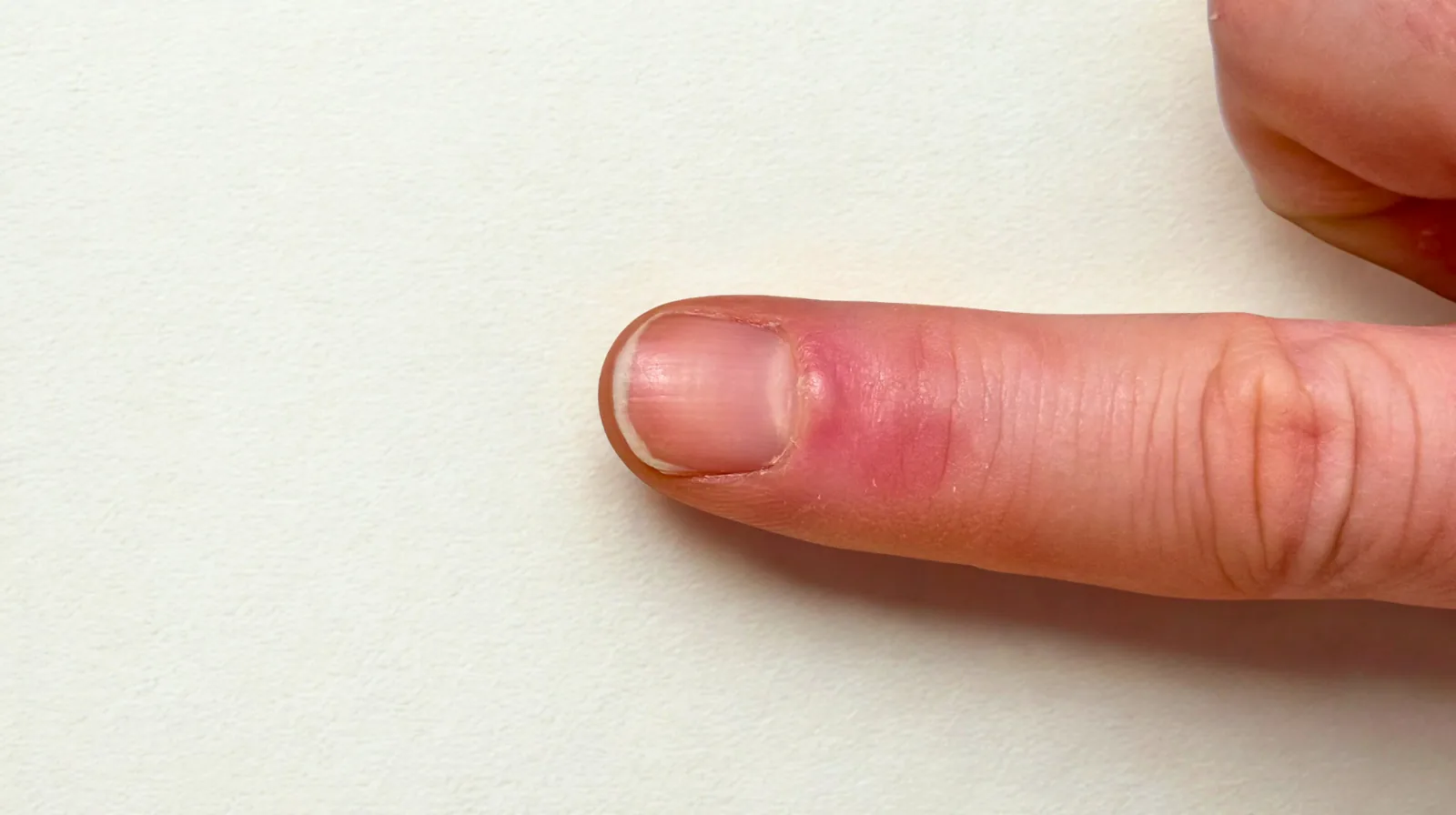 A close-up of a persons index finger with redness and swelling around the nail, indicating possible infection or irritation, against a plain light background.