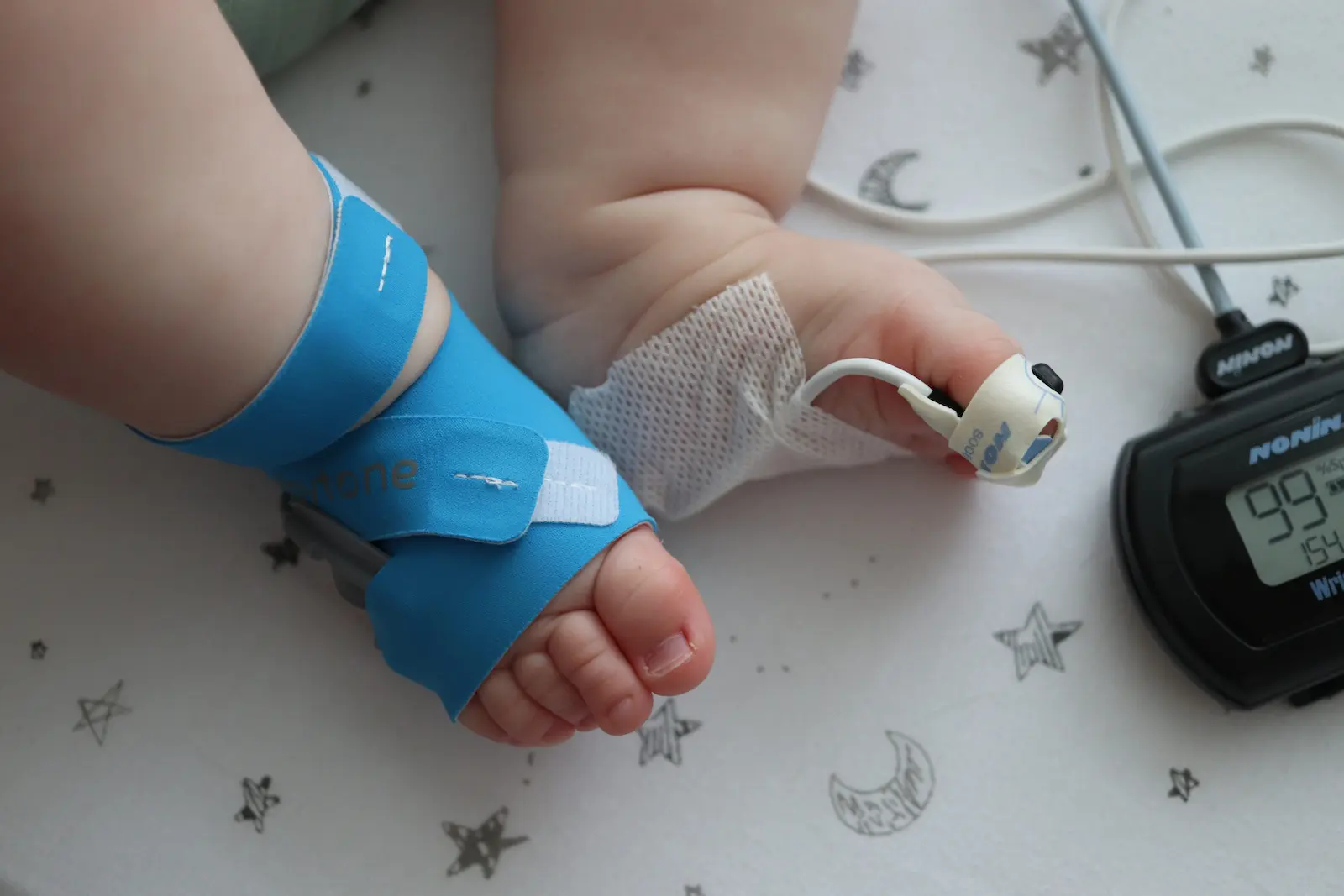Baby foot with blue splint and hand with Nonin pulse oximeter sensor showing 99% oxygen saturation reading